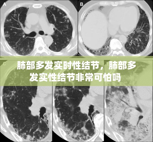 肺部多发实时性结节，肺部多发实性结节非常可怕吗 